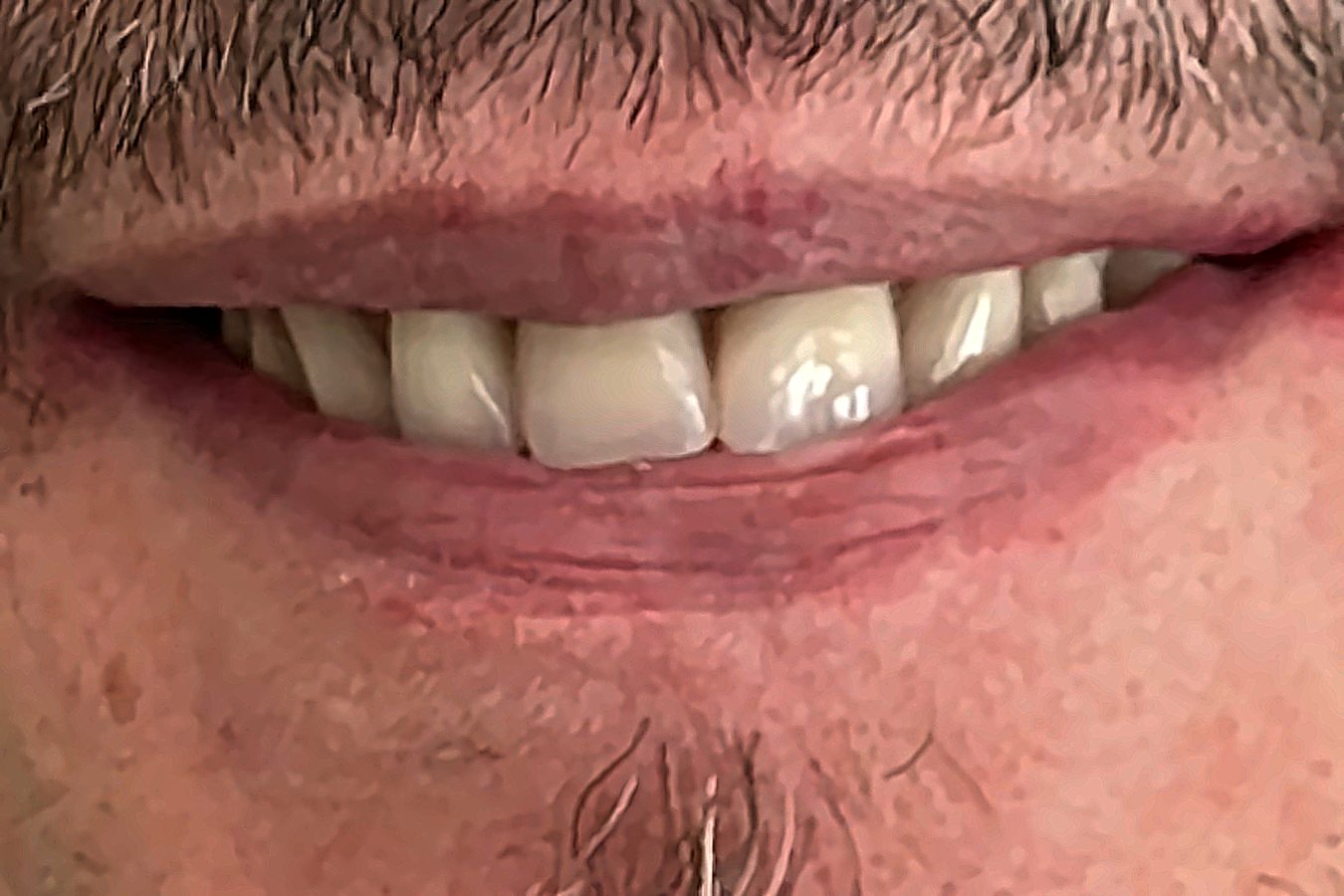 Dopo il trattamento