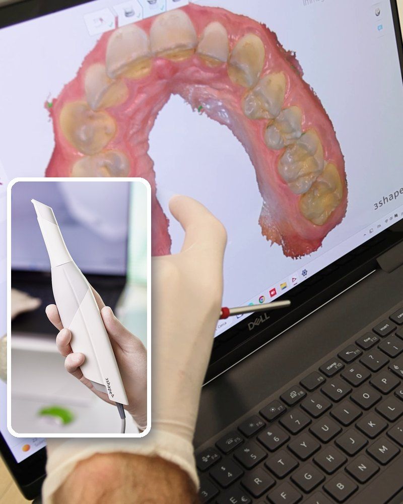 Scanner intraorale