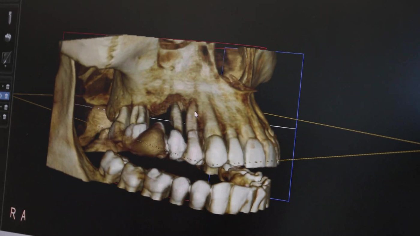 TAC 3D per la chirurgia guidata