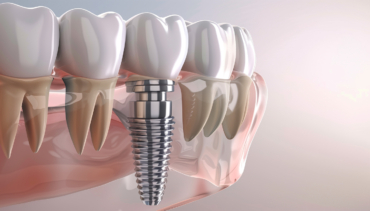 Chirurgia Implantare