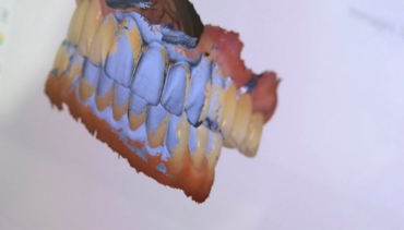 Chirurgia Implantare
